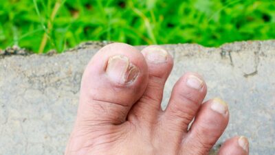 Descubre 5 tipos de hongos en la piel y cómo identificarlos