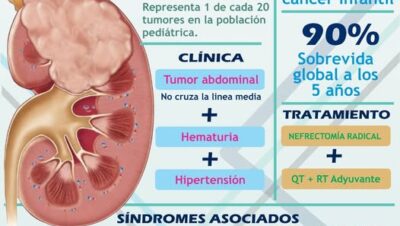 Tumor de Wilms: causas, síntomas y tratamiento